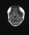 Chronic reactive multifocal osteomyelitis (CRMO) - mandible (Radiopaedia 56405-63069 Axial T1 10).jpg