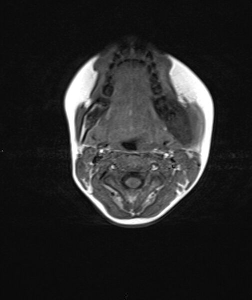 File:Chronic reactive multifocal osteomyelitis (CRMO) - mandible (Radiopaedia 56405-63069 Axial T1 10).jpg