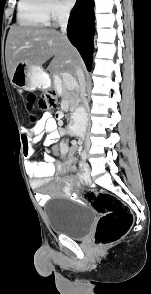 File:Chronic small bowel volvulus (Radiopaedia 75224-86322 C 80).jpg