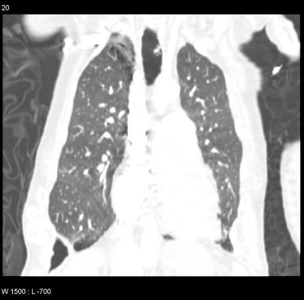File:Clagett thoracotomy (Radiopaedia 8568-9403 Coronal lung window 20).jpg