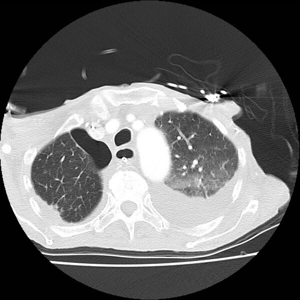 File:Clagett thoracotomy with bronchopleural fistula (Radiopaedia 29192-29587 Axial lung window 11).jpg
