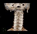 Clay-shoveler fracture (Radiopaedia 22568-22590 3D VR 8).jpg