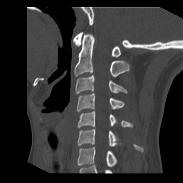 File:Clay-shoveler fracture (Radiopaedia 22568-22590 Sagittal bone window 19).jpg