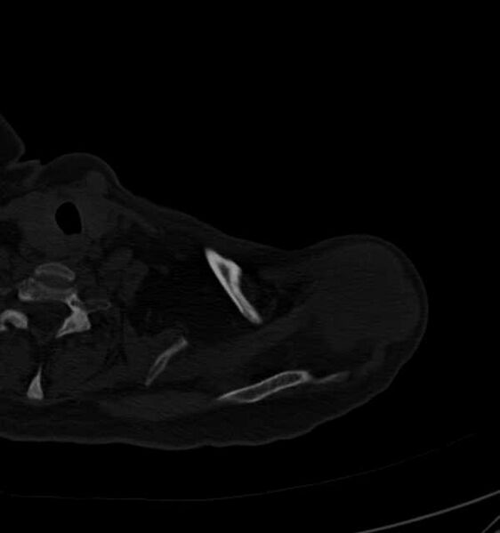 File:Clear cell chondrosarcoma - humerus (Radiopaedia 63104-71612 Axial bone window 15).jpg