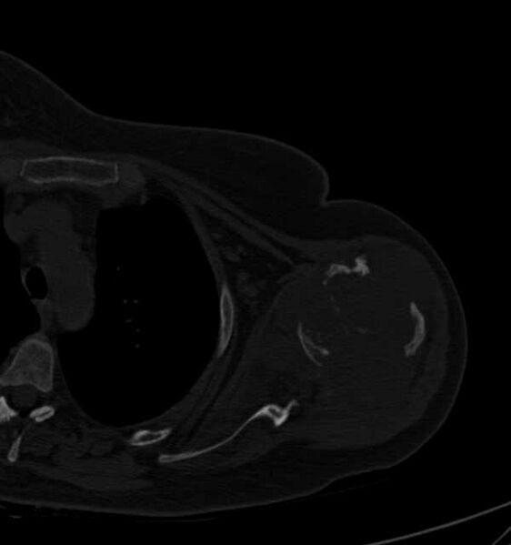 File:Clear cell chondrosarcoma - humerus (Radiopaedia 63104-71612 Axial bone window 49).jpg