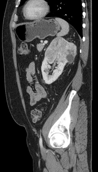 File:Clear cell renal cell carcinoma (Radiopaedia 61449-69393 G 24).jpg