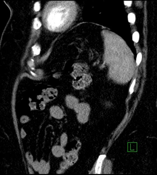 File:Clear cell renal cell carcinoma (Radiopaedia 85004-100537 D 13).jpg