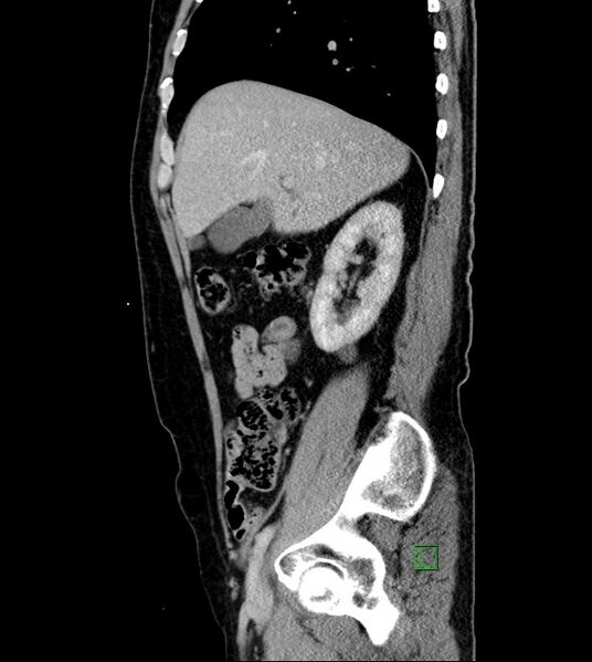 File:Clear cell renal cell carcinoma (Radiopaedia 85006-100539 G 44).jpg