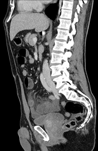 File:Closed loop small bowel obstruction - internal hernia (Radiopaedia 57806-64778 C 60).jpg