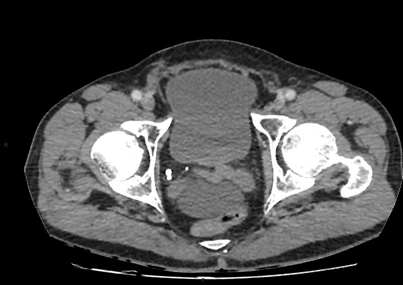 File:Closed loop small bowel obstruction with ischemia (Radiopaedia 84180-99456 A 113).jpg