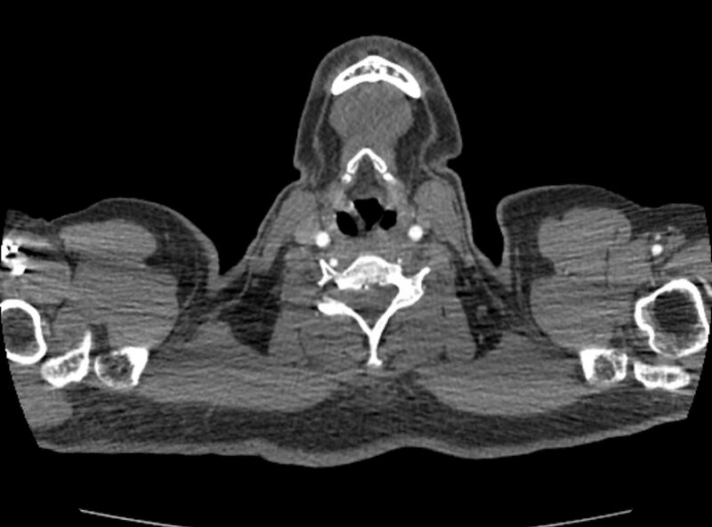 File:Coarctation of the aorta (Radiopaedia 53363-59343 A 1).jpg