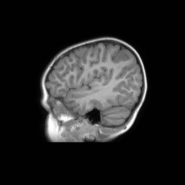 File:Cochlear nerve aplasia - unilateral (Radiopaedia 87910-104413 Sagittal T1 11).jpg