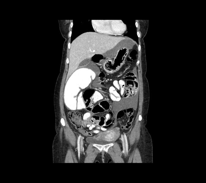 File:Cocoon abdomen with possible tubo-ovarian abscess (Radiopaedia 46235-50636 B 18).jpg