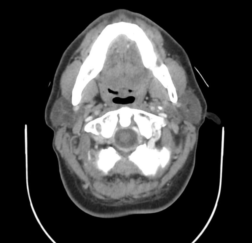 Colloid cyst of thyroid (Radiopaedia 22897-22923 Axial C+ delayed 23).jpg