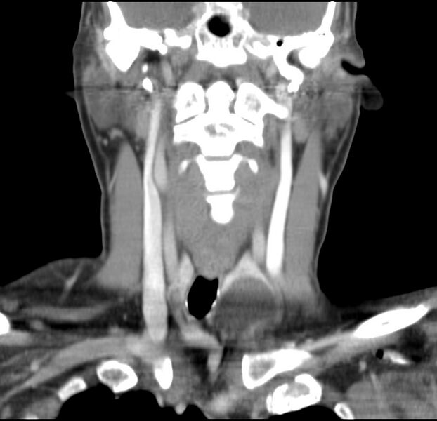 File:Colloid cyst of thyroid (Radiopaedia 22897-22923 Coronal C+ delayed 31).jpg
