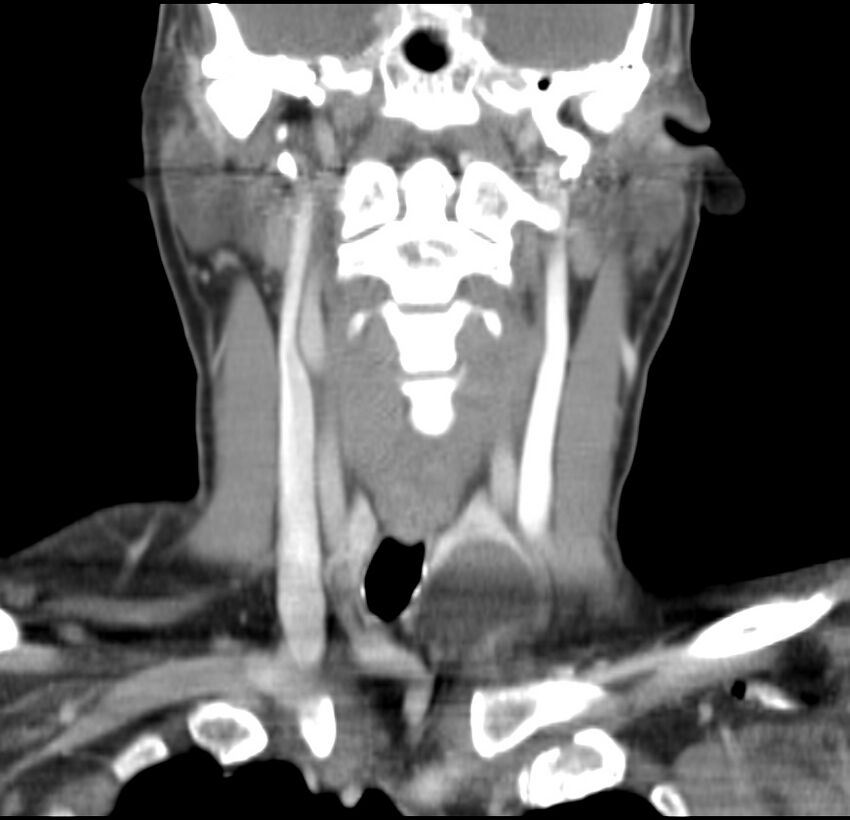 Colloid cyst of thyroid (Radiopaedia 22897-22923 Coronal C+ delayed 31).jpg