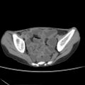 Colocolic fistula - Crohn disease (Radiopaedia 57063-63955 A 76).jpg