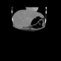 Colocolic fistula - Crohn disease (Radiopaedia 57063-63955 B 3).jpg