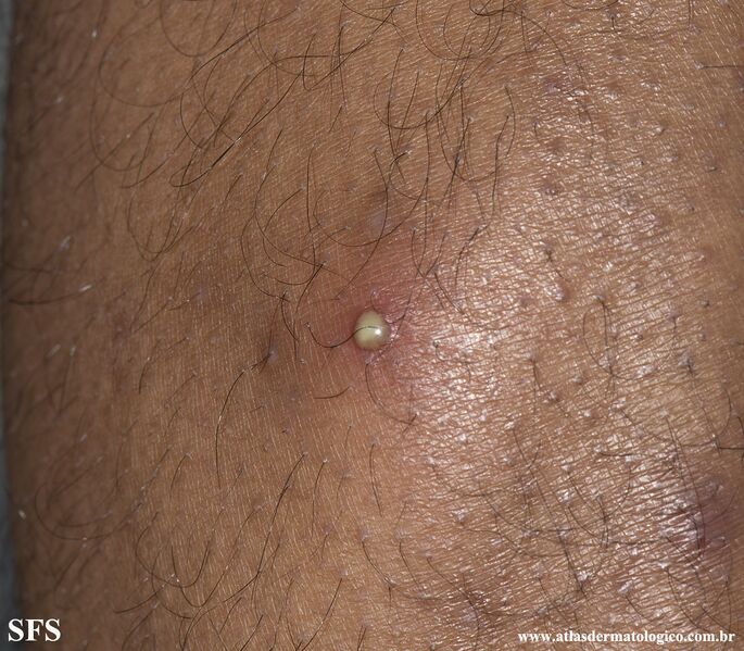 File:Folliculitis (Dermatology Atlas 16).jpg