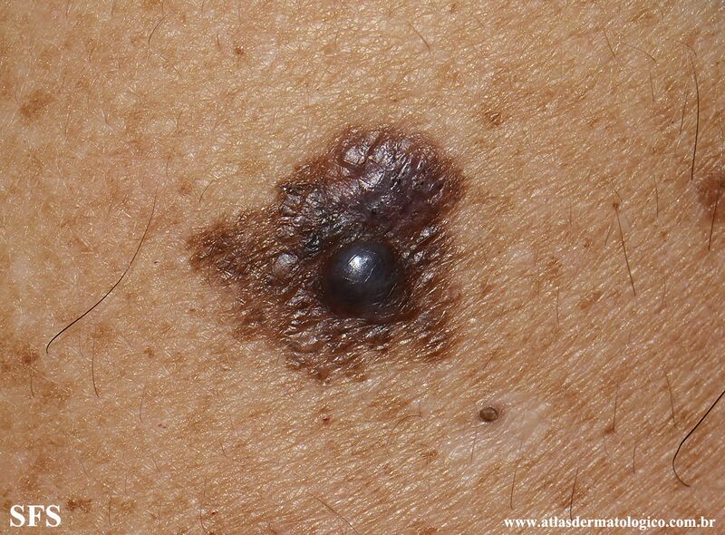 File:Melanoma (Dermatology Atlas 109).jpg