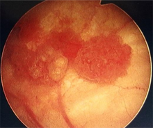 Cystoscopy: multiple papillary tumors on the right side of the posterior wall