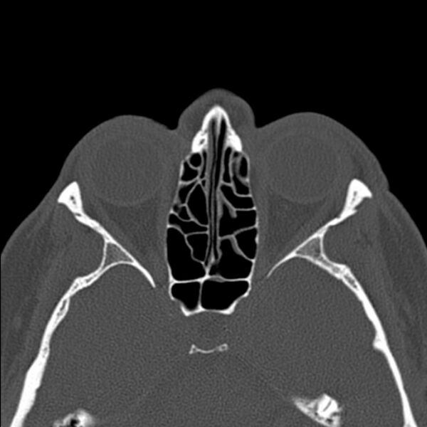 File:Nasal septal perforation (Radiopaedia 25030-25289 Axial bone window 40).jpg
