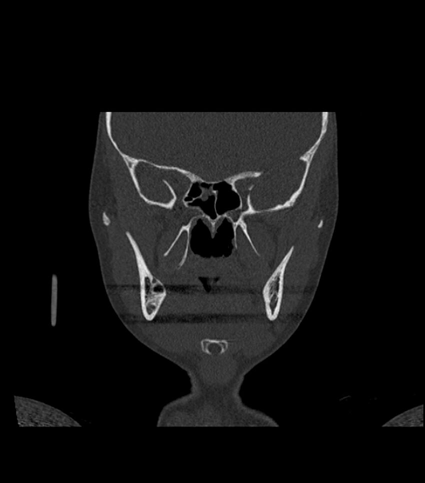 Nasoorbitoethmoid fracture (Radiopaedia 90044-107205 Coronal bone window 67).jpg