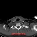 Nasopharyngeal carcinoma recurrence - skull base destruction (Radiopaedia 29107-29491 A 32).jpg