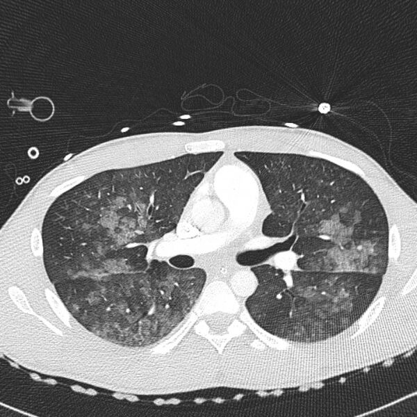 File:Near drowning (pulmonary edema) (Radiopaedia 24685-24958 lung window 21).jpg