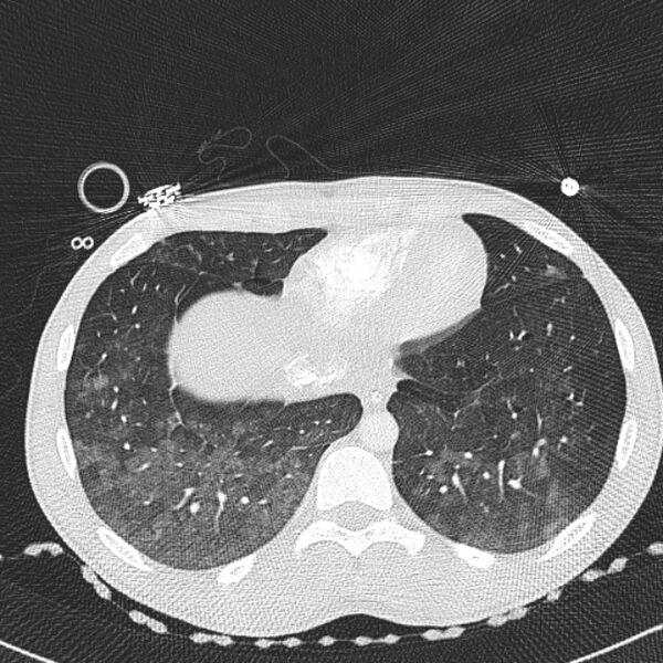 File:Near drowning (pulmonary edema) (Radiopaedia 24685-24958 lung window 66).jpg