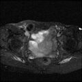 Necrotizing epididymo-orchitis with intra-testicular abscess (Radiopaedia 29397-29860 Axial T2 fat sat 1).jpg