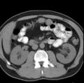 Necrotizing pancreatitis with acute necrotic collection (Radiopaedia 14470-14417 Axial non-contrast 21).jpg