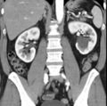 Necrotizing pancreatitis with acute necrotic collection (Radiopaedia 14470-14417 C 27).jpg