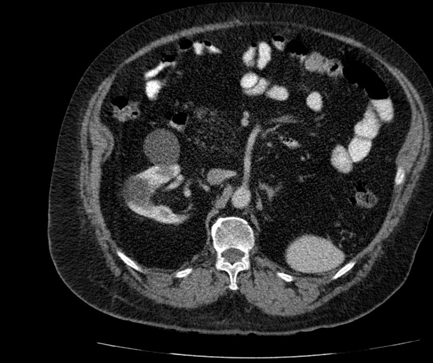 Nephroptosis with inguinal hernia containing perirenal fat (Radiopaedia 56632-63391 C 136).jpg