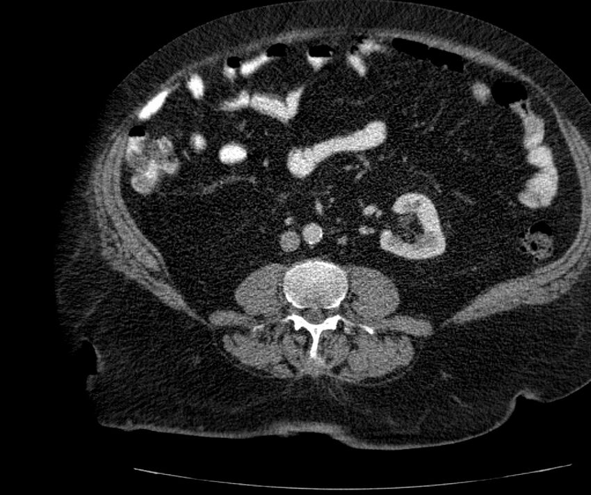 Nephroptosis with inguinal hernia containing perirenal fat (Radiopaedia 56632-63391 C 192).jpg