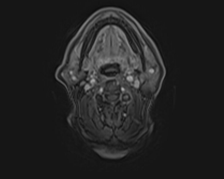 File:Non-Hodgkin lymphoma - parotid gland (Radiopaedia 71531-81890 E 6).jpg