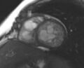Non-compaction of the left ventricle (Radiopaedia 69436-79314 Short axis cine 119).jpg