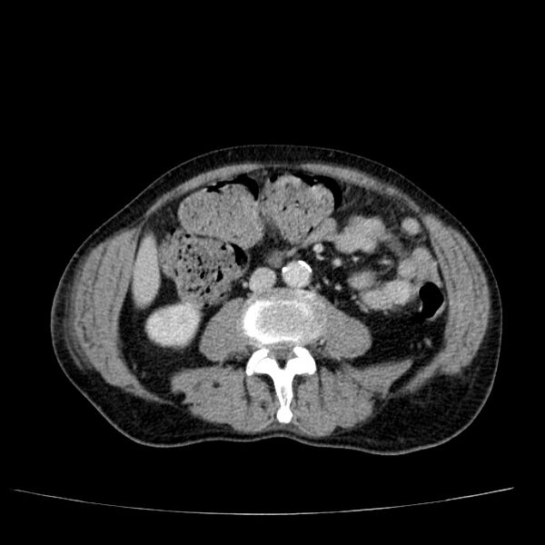 File:Non small-cell lung cancer (Radiopaedia 24467-24769 C+ delayed 82).jpg