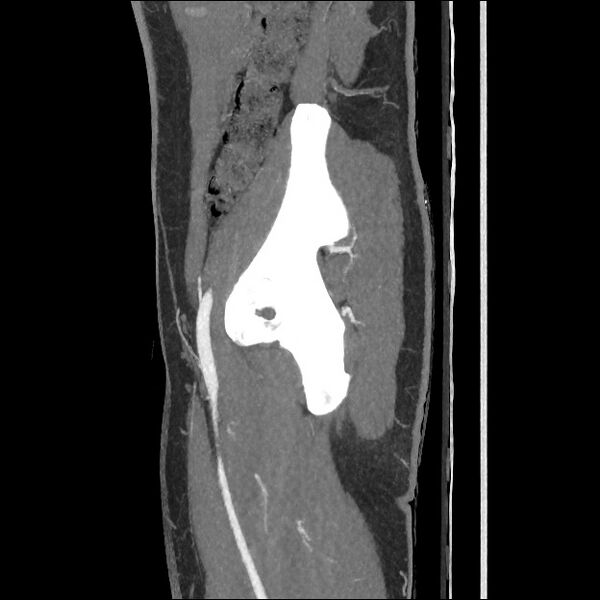 File:Normal CT angiogram of pelvis (Radiopaedia 45390-49430 C 51).jpg