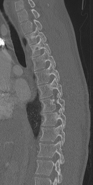 File:Normal CT thoracic spine (Radiopaedia 40181-42688 Sagittal bone window 41).png