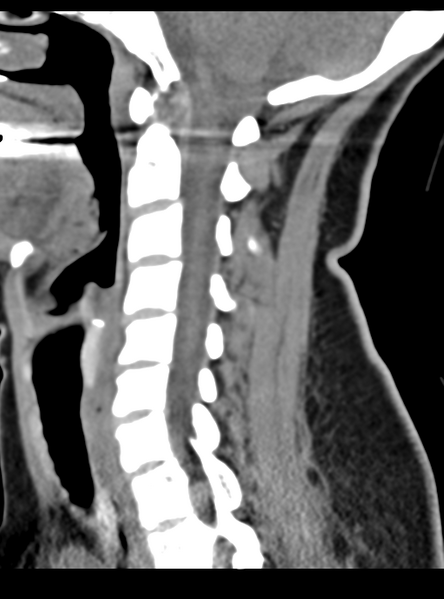 File:Normal cervical spine MRI (including Dixon) (Radiopaedia 42762-45926 C 27).png