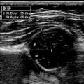 Normal hip ultrasound - infant (Radiopaedia 2718-6410 B 1).jpg