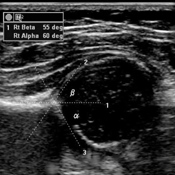 File:Normal hip ultrasound - infant (Radiopaedia 2718-6410 B 1).jpg