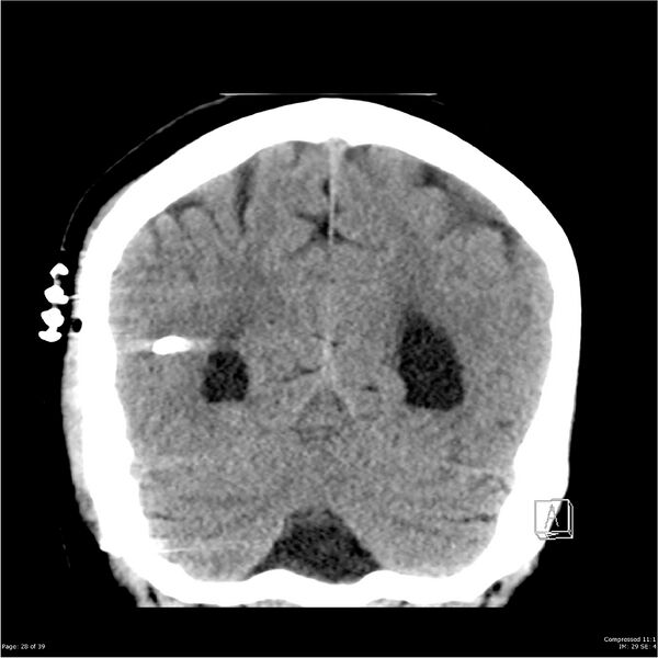 File:Normal pressure hydrocephalus (Radiopaedia 24415-24736 Coronal non-contrast 24).jpg