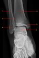 Normal radiographic anatomy of the ankle (Radiopaedia 42814-45987 A 1).jpg