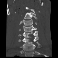 Normal trauma cervical spine (Radiopaedia 41017-43760 Coronal bone window 13).png