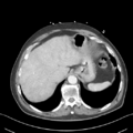 Nutmeg liver (Radiopaedia 49958-55246 A 11).png