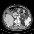 Nutmeg liver (Radiopaedia 49958-55246 A 23).png