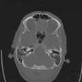 Obstructive hydrocephalus (Radiopaedia 30453-31119 Axial bone window 25).jpg