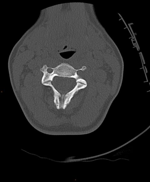 File:Occipital condyle fracture (Radiopaedia 61165-69056 D 14).jpg